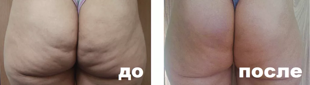 ReFit до после в описание 2.png ReFit до после в описание 2.png
